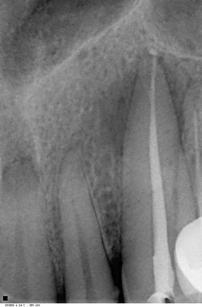 After extraction of the failing premolar and root canal therapy on the canine — disinfection and obturation complete.