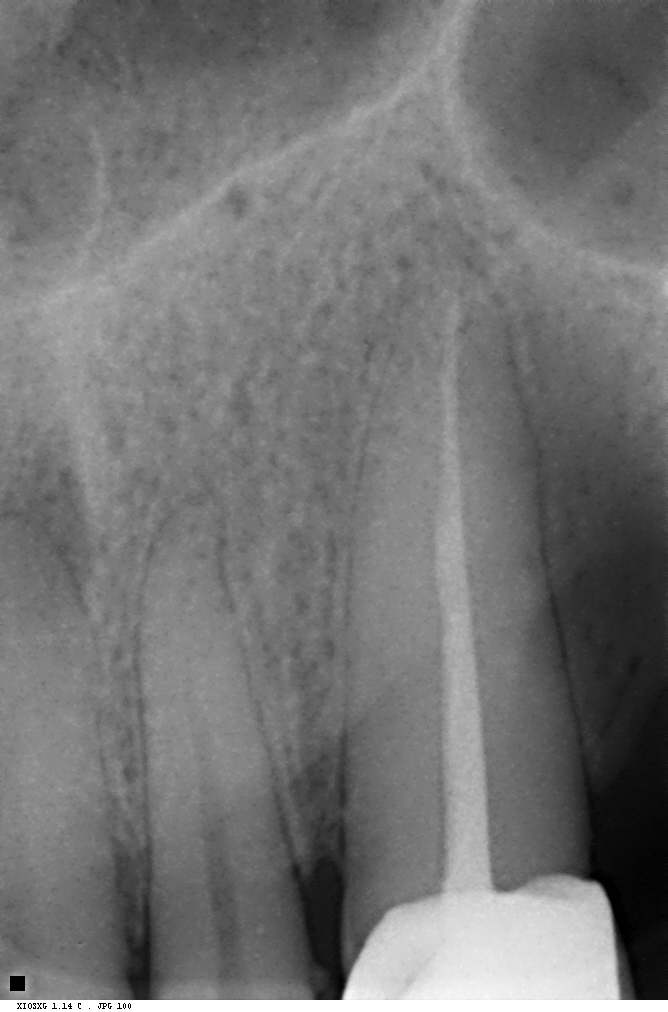 Follow-up radiograph showing complete bony healing around the canine root apex. No residual infection.