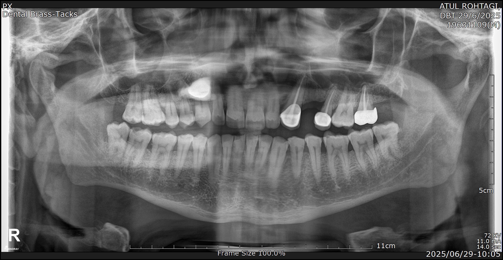Full-mouth OPG showing the healed upper left canine and extraction site of the previously failing premolar.